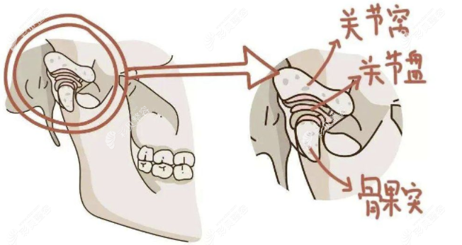 颞颌关节紊乱能不能正畸?我牙齿矫正改善了颞下颌关节紊乱