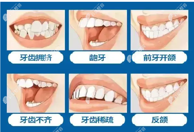 适合做正畸的症状