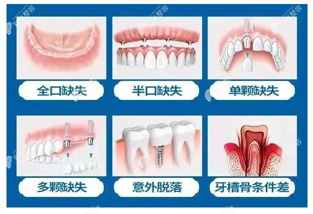 秦皇岛锐博口腔段宏宇医生种植牙怎么样 cbzr.com