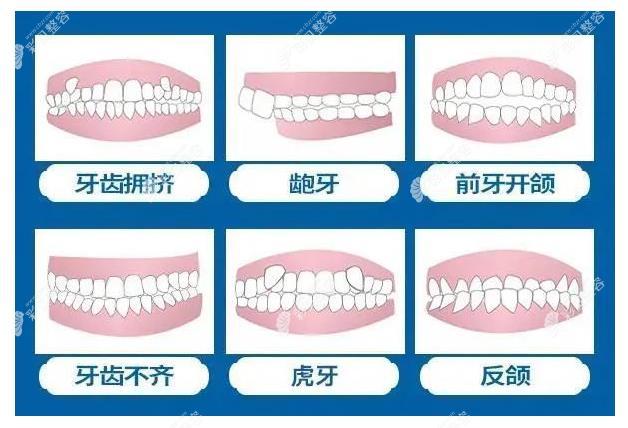 胥杨医生做牙齿矫正怎么样